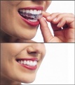 Invisalign London.jpg