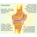 Best Arthritis Treatment.jpg