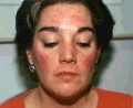 Rosacea treatment.jpg